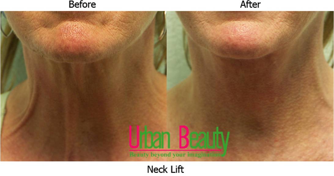 neck lift surgery thailand