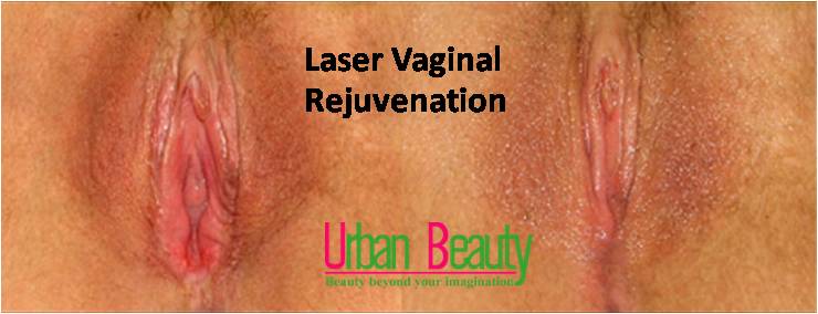 laser viginal rejuvenation thailand