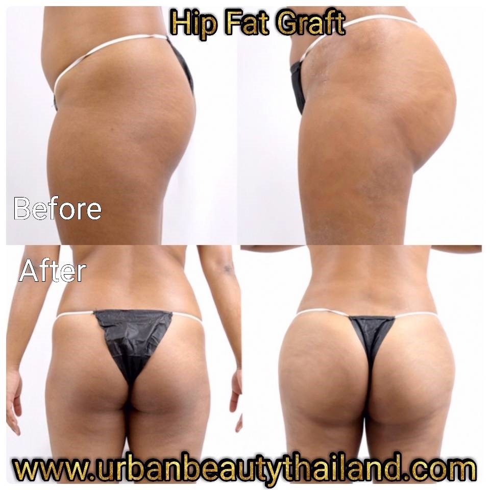 Butt Augmentation in Thailand  Interplast Clinic Bangkok, Thailand