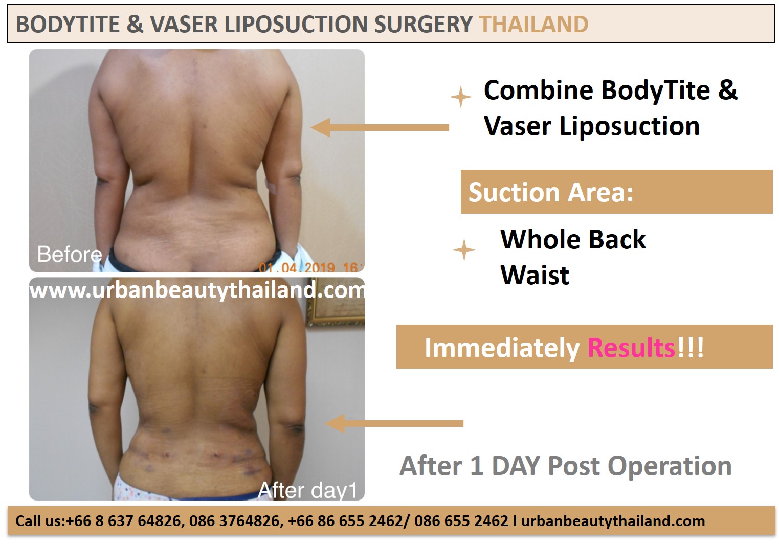 Back Lift Surgery - Eliminating Back Fat Rolls with the New Bra-Line -  Urban Beauty Thailand