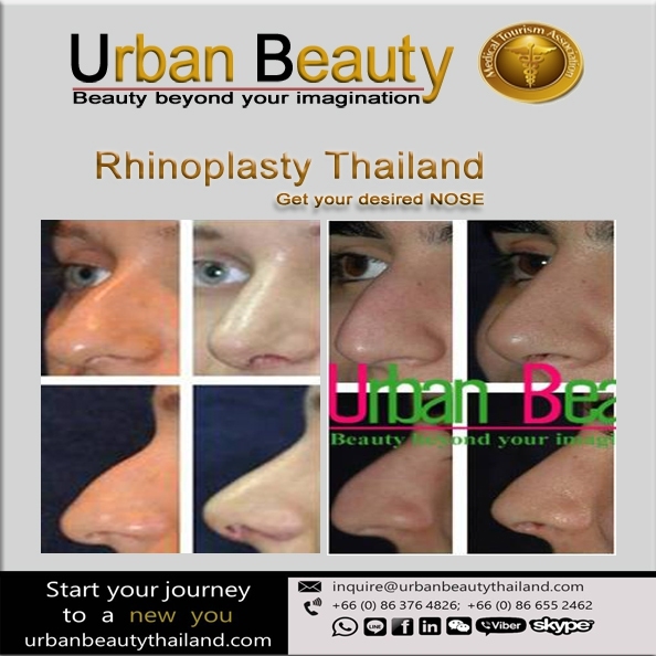 Rhinoplasty_thailand