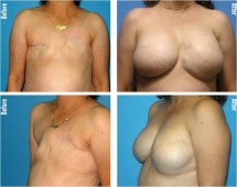 breast cancer-breast-augmentation-bangkok-thailand