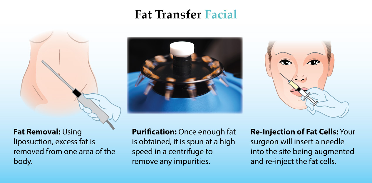 fat-transfer-thailand