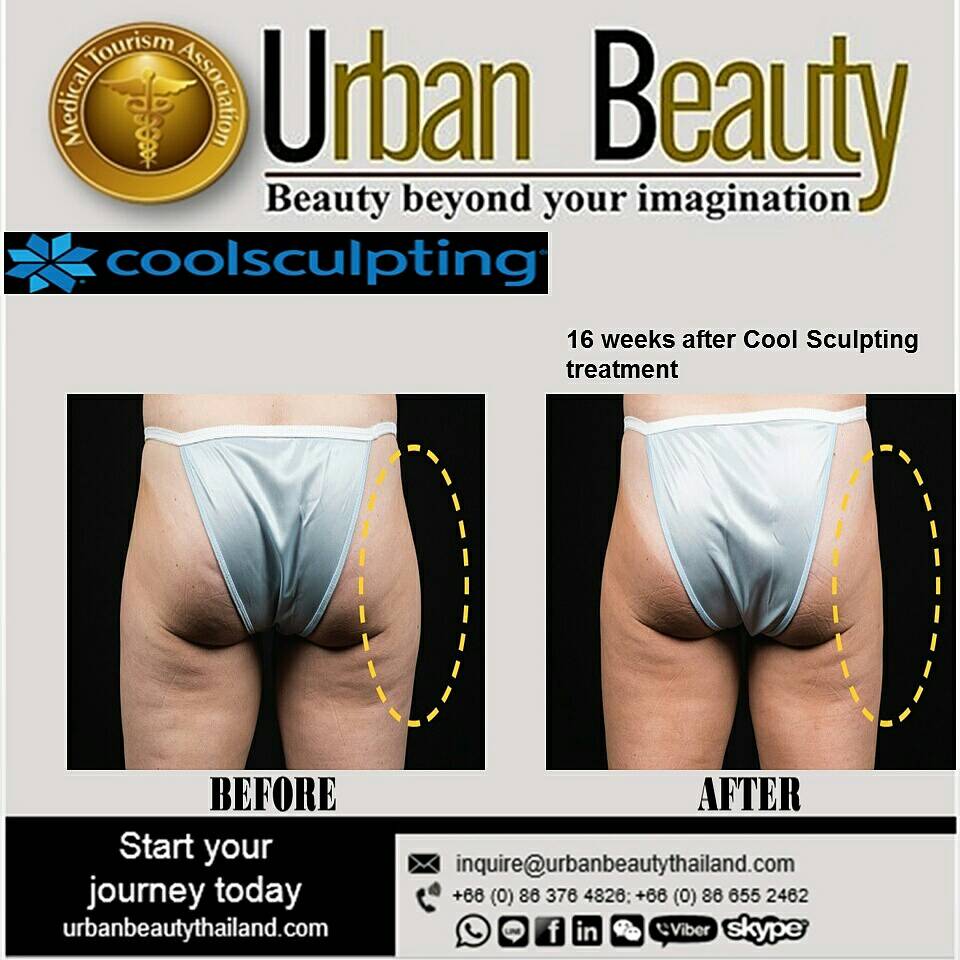 coolsculptingzeltiqthailand