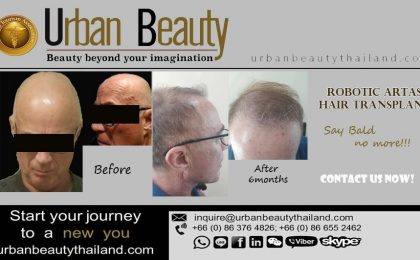 Robot Hair Transplant Thailand, Hair Transplant Bangkok Thailand
