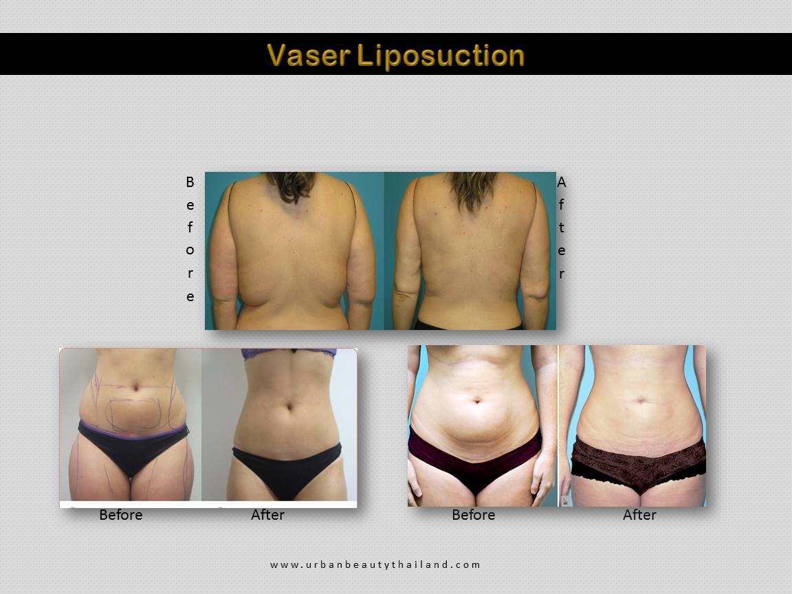 vaser liposuction hi def thailand