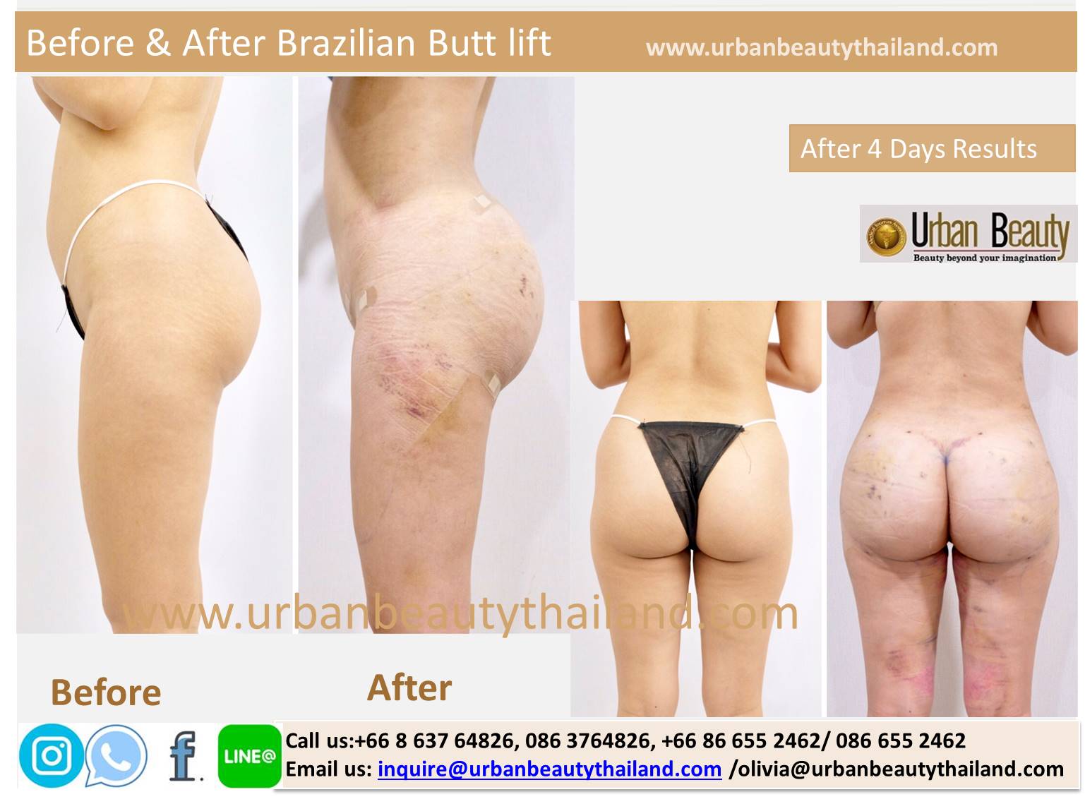 New Year Great Saving Deals: Butt Augmentation/Brazilian Butt lift  Thailand/Liposuction Fat transfer Thailand buttock augmentation bangkok  thailand