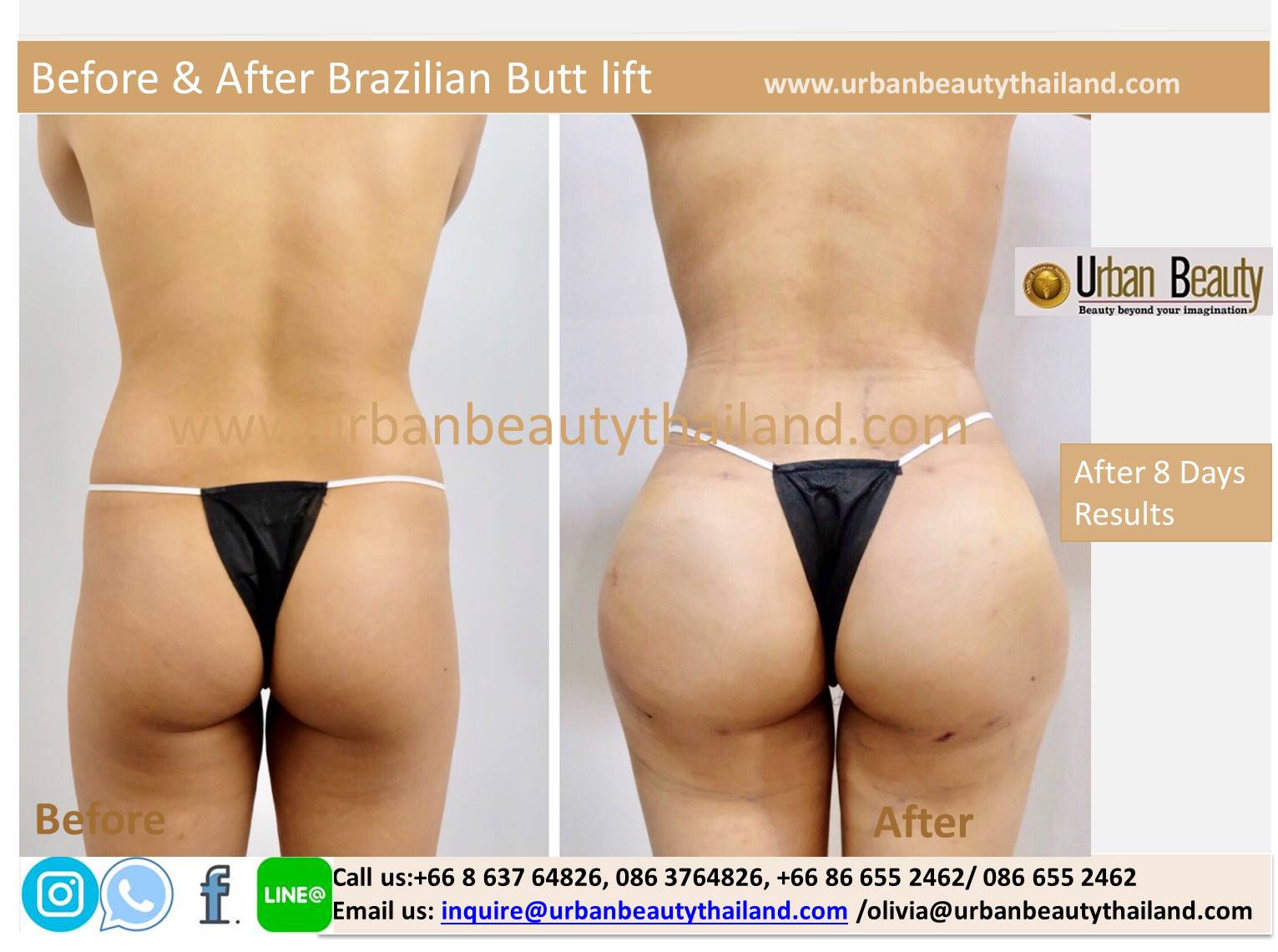 Buttock Augmentation - Urban Beauty Thailand