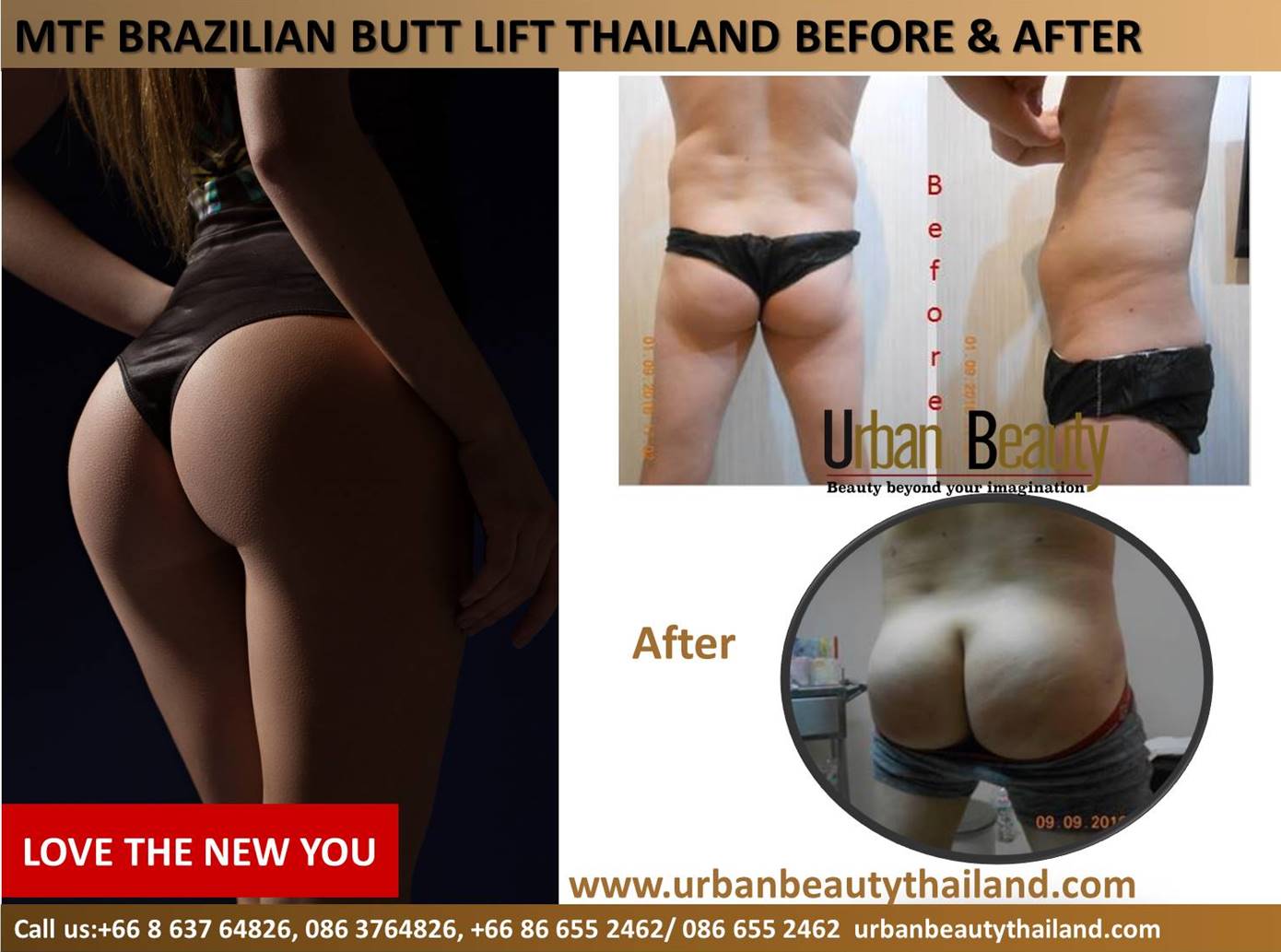 Brazilian Butt Lift Thailand, Stem Cell Fat Graft Butt Lift Bangkok