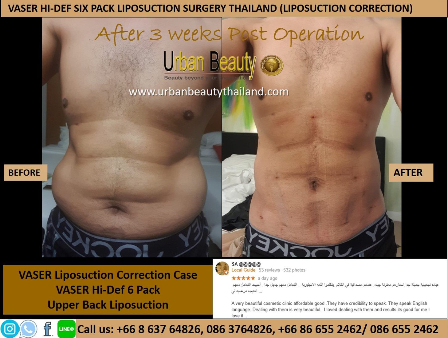 Vaser Liposuction Body Contouring, Hi Def Lipo