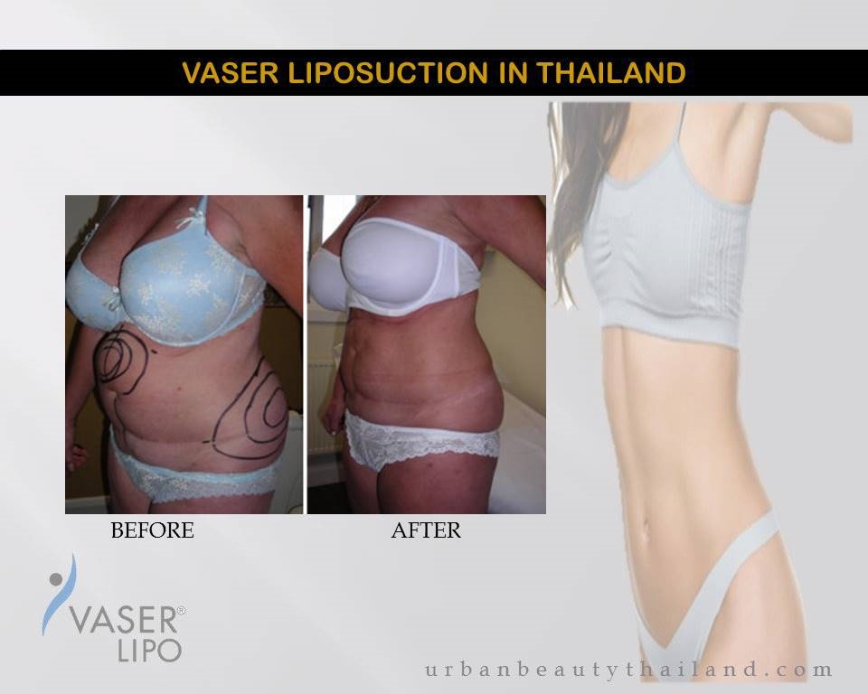 fat removal liposuction bangkok