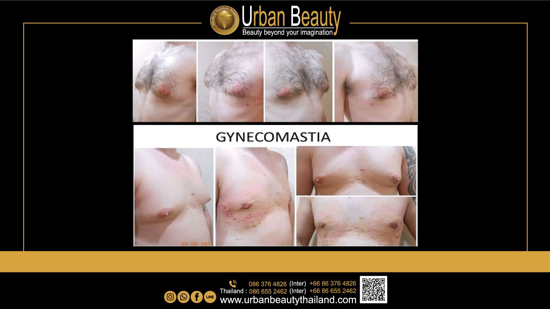 Male Breast Reduction Gynecomastia Thailand Urban Beauty Thailand