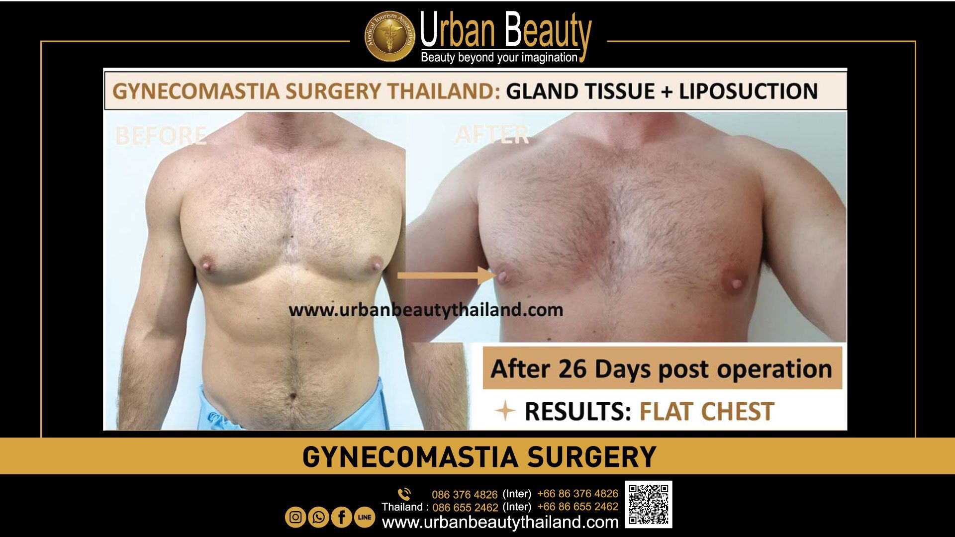 Male Breast Reduction Gynecomastia Thailand Urban Beauty Thailand