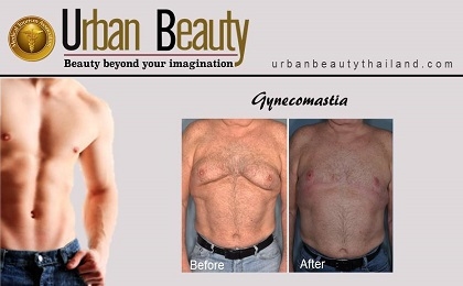 gynecomastia-breast-removal-bangkok-thailand