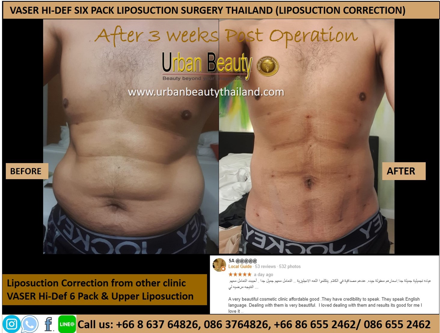 Abdominal Sculpting (6-pack) Before and After - Bluewater Plastic