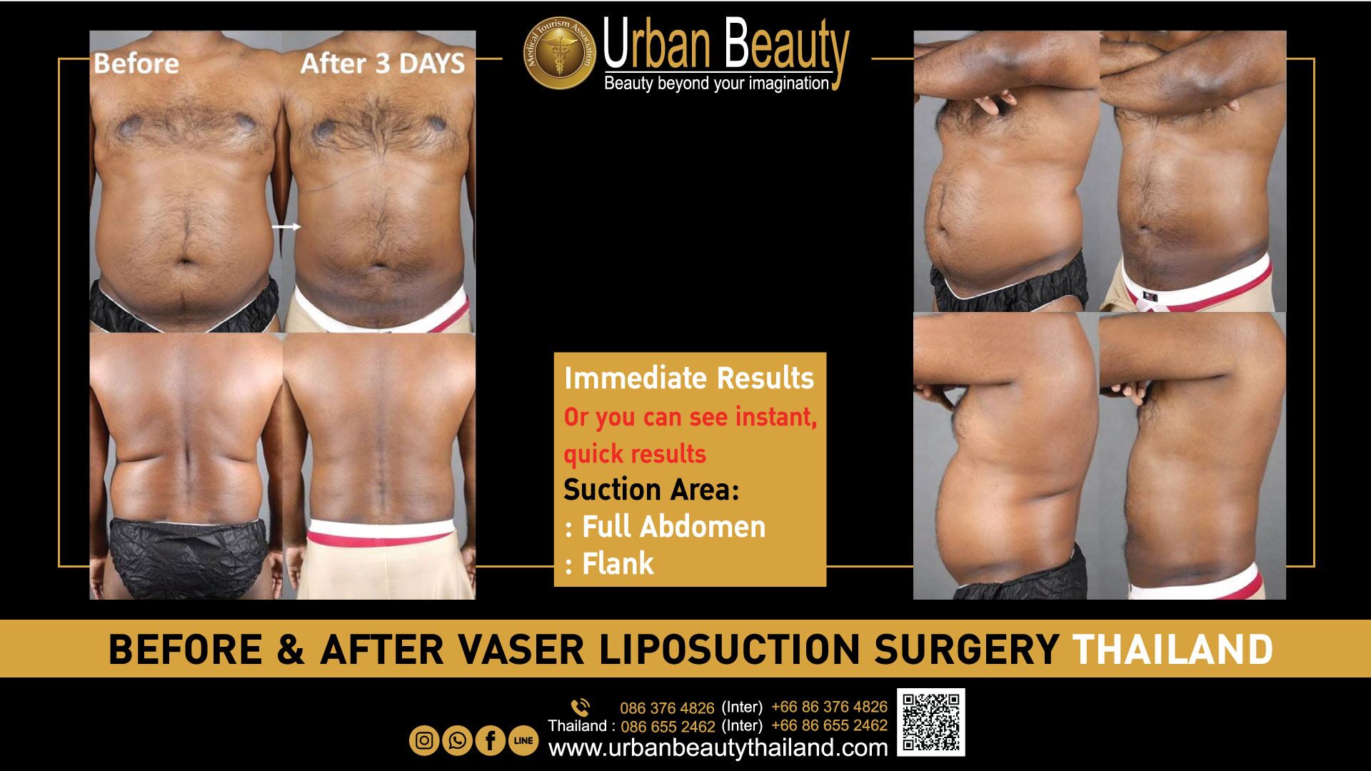 Full Body Liposuction Cost