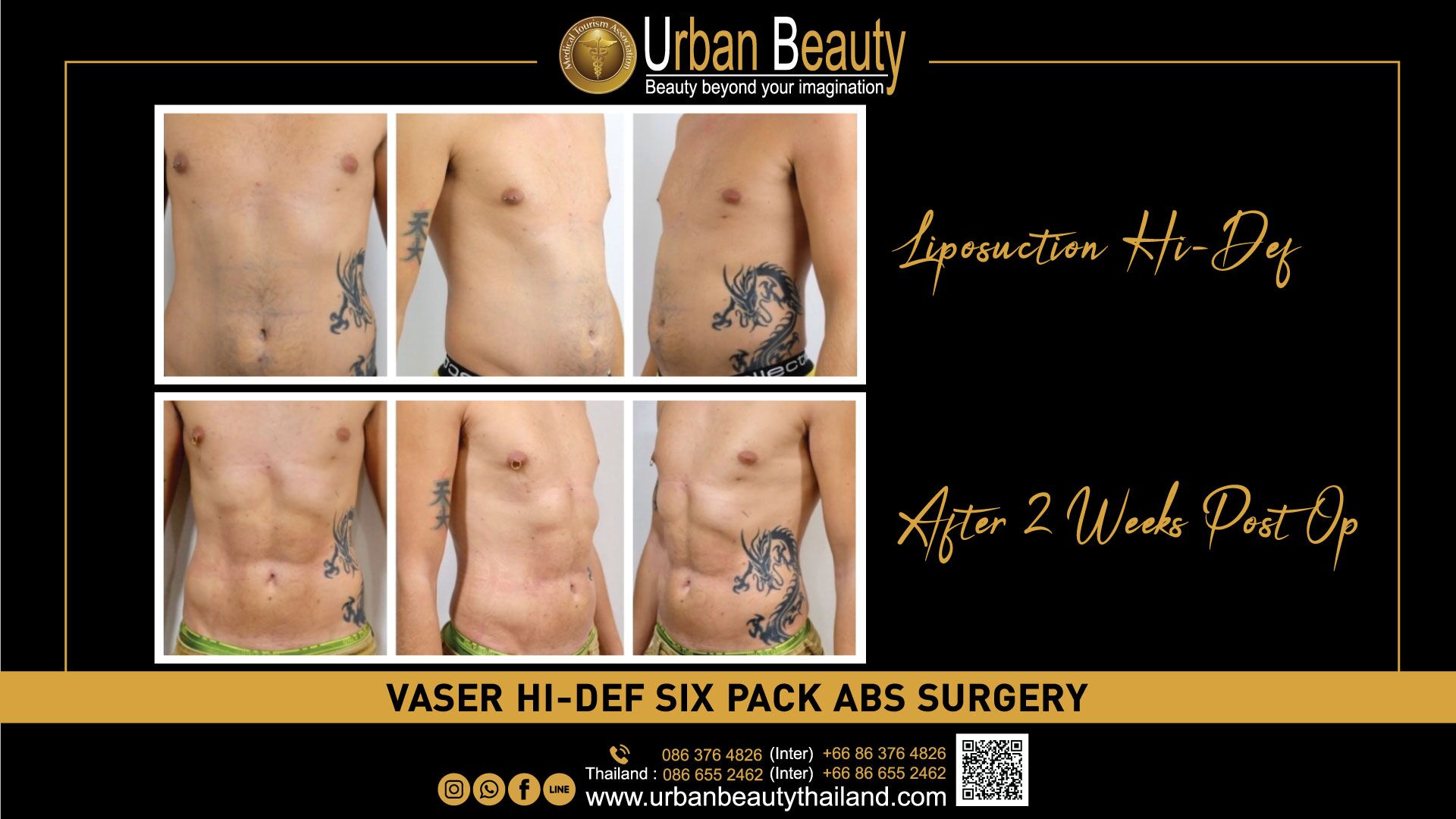 Ab Sculpting  Hi Def Liposuction - A New You