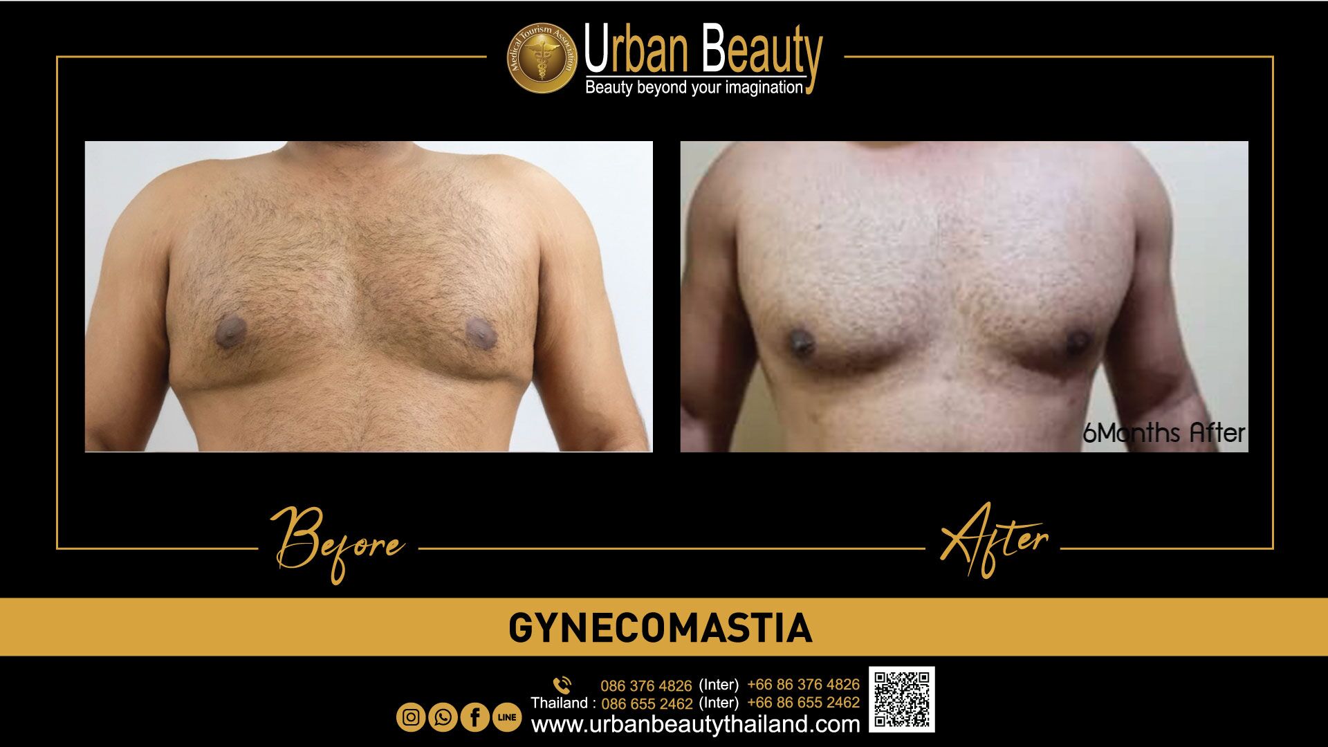 Male Breast Reduction Gynecomastia Thailand Urban Beauty Thailand