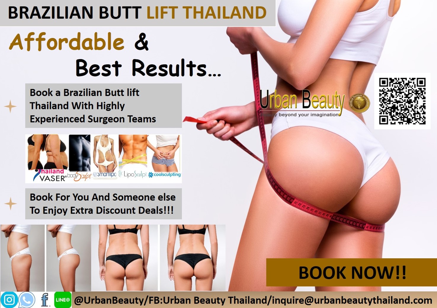 Fat Grafting to Buttock (Brazilian Butt Lift) Results: Before and