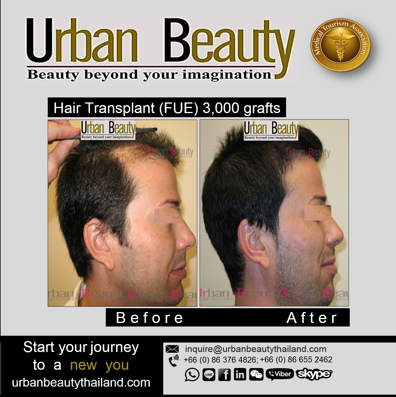 FUE Hair Loss Solutions Thailand /Grow Back Your Hair in Thailand /Hair  Transplant Thailand - Urban Beauty Thailand