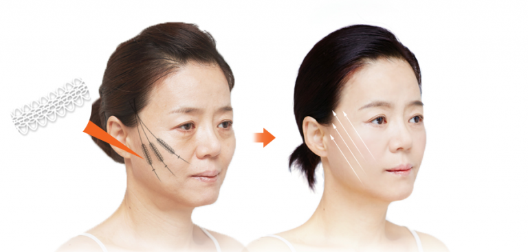 Revolutionary Endotine Ribbon Lift Facelift Thailand - Urban Beauty ...