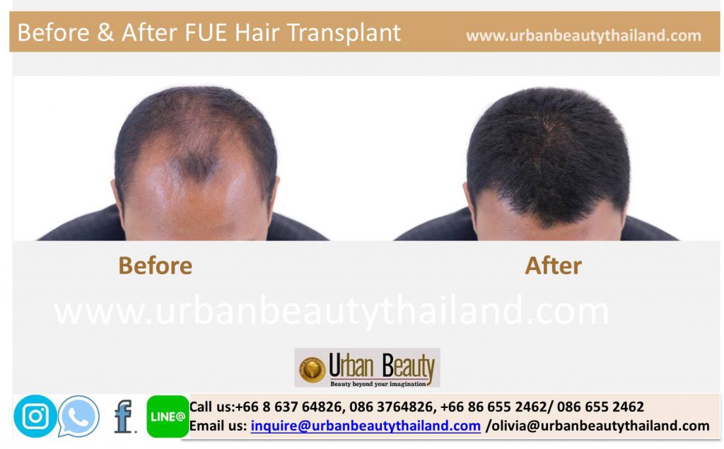 FUE Hair Loss Solutions Thailand /Grow Back Your Hair in Thailand /Hair