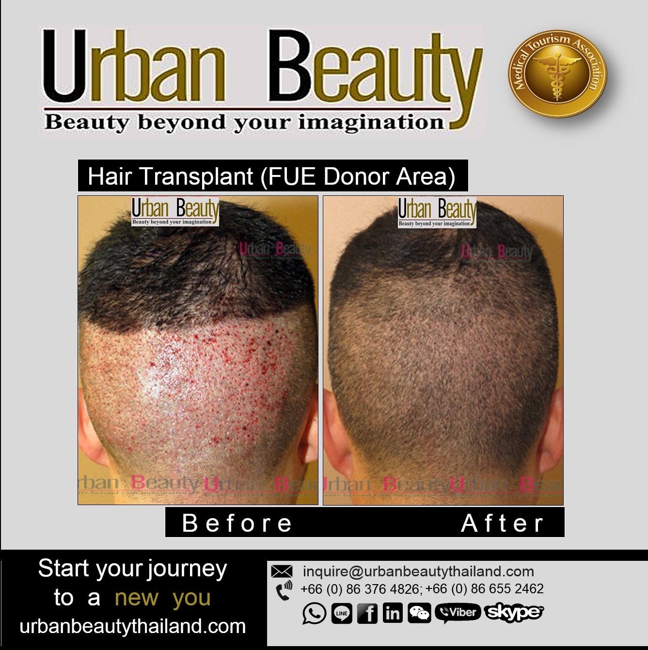 hair transplant fue thailand