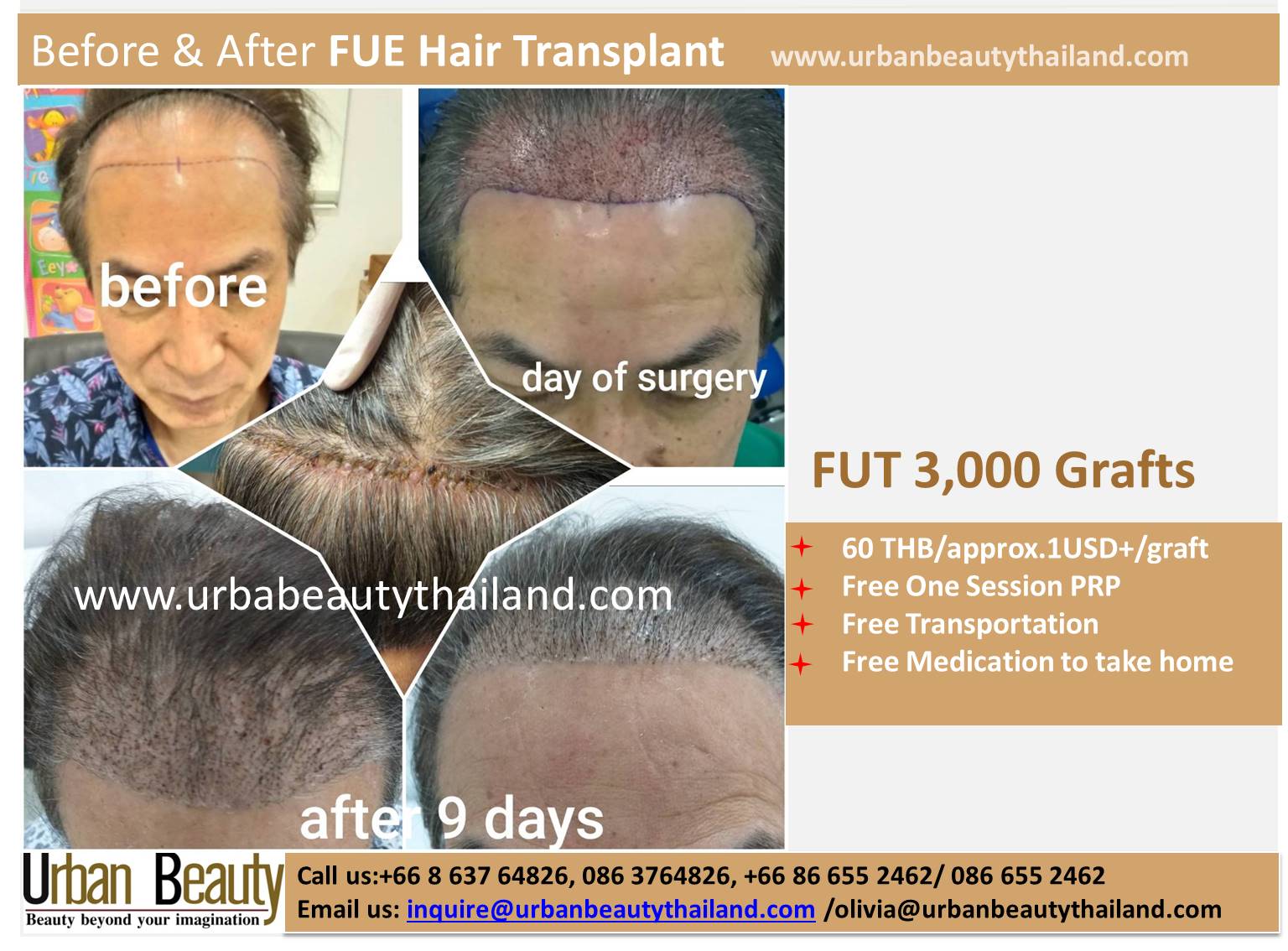 FUE Hair Loss Solutions Thailand /Grow Back Your Hair in Thailand /Hair  Transplant Thailand - Urban Beauty Thailand