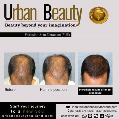 hair transplant thailand