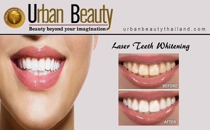laser-teeth-whitening-thailand