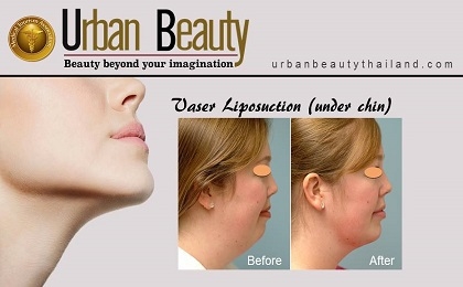 neck liposuction thailand