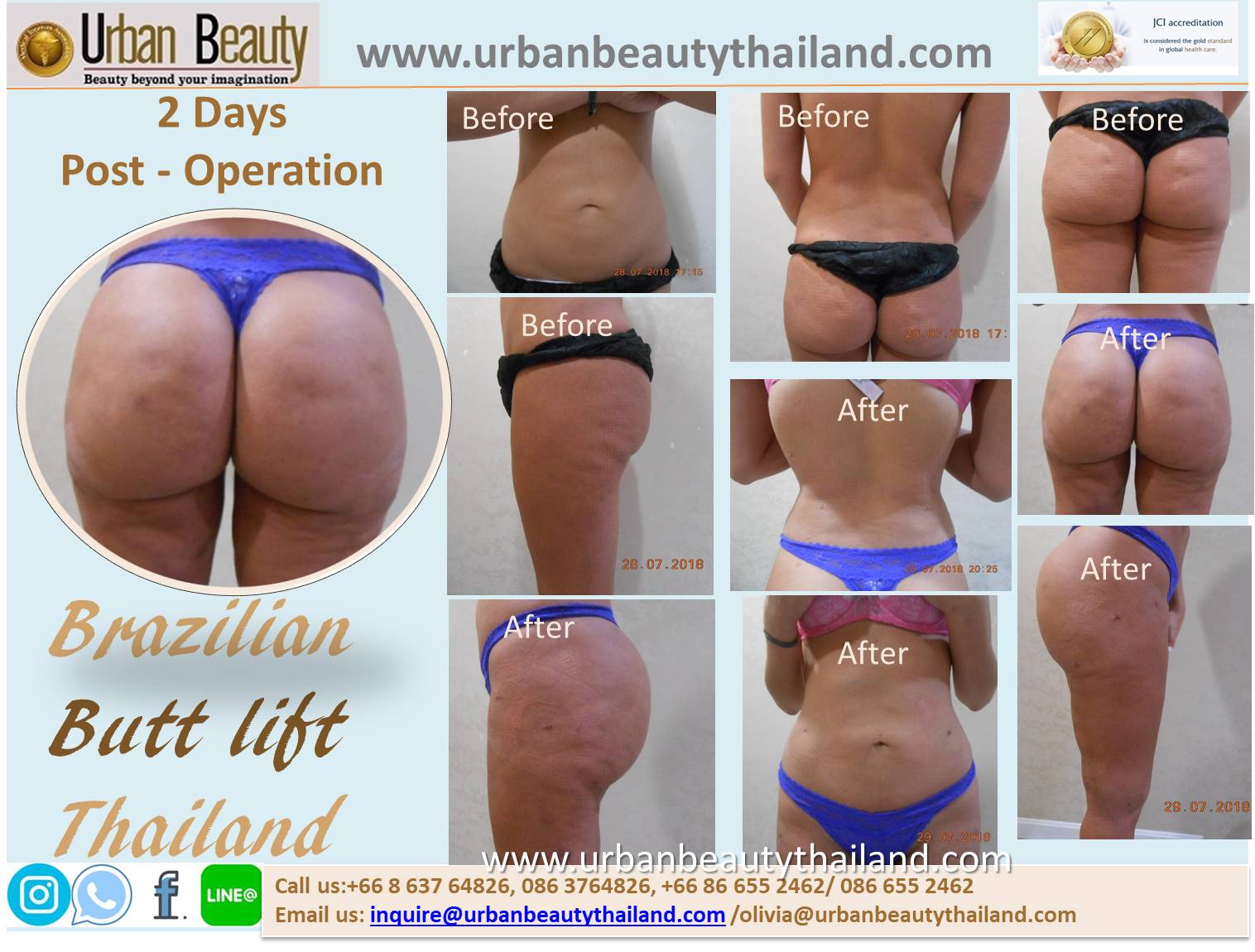 Buttock Augmentation - Urban Beauty Thailand