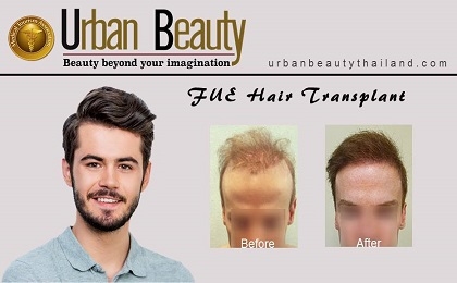 fue-hair-transplant-bangkok