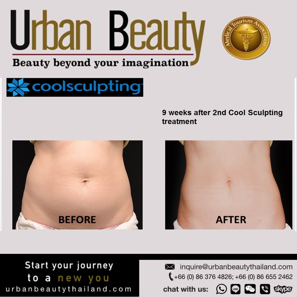 CoolSculpting Thailand by Zeltiq, Reduce fat on Your New Year - Urban  Beauty Thailand