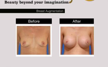 Breast Augmentation Thailand/ Natural Breast Fat Transfer