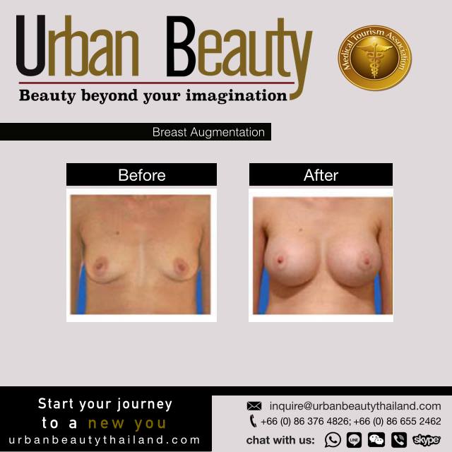 breast-augmentation-thailand-bangkok-phuket