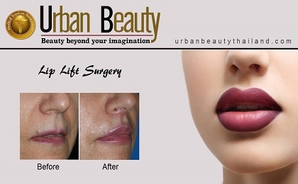 Lip Lift Surgery Thailand
