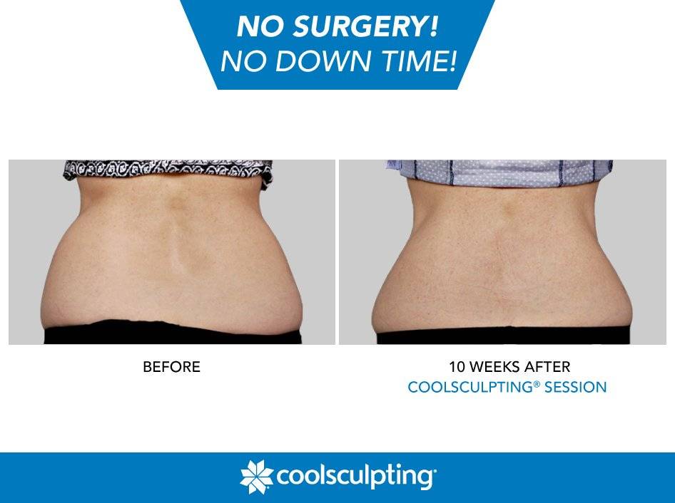 cooladvantage-coolsculpting-bangkok-phuket