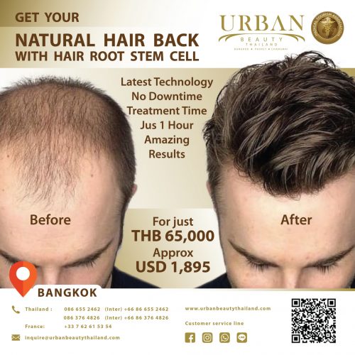 Best Price Hair Root Stem Cell Treatment Thailand - Hair Transplant save up  to 70% Bangkok, Thailand - Urban Beauty Thailand