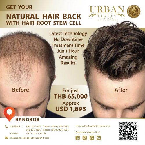 Hair Transplant Case Study