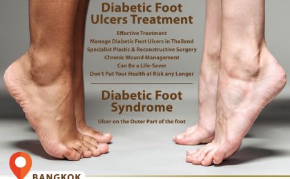 Heal the Pain with Diabetic Foot Ulcer Treatment in Thailand