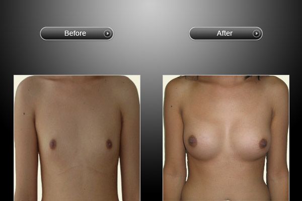 mtf-breast-augmentation