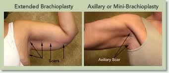 arm-lift-thailand-liposuction-vaser-liposuction-laser-liposuction-plastic-surgery-thailand