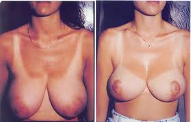 Breast Reduction Thailand