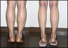 Calf Reduction Surgery At Home & Abroad