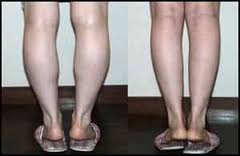 calf-reduction-thailand-bangkok-cosmetic-surgery-thailand-plastic-surgery-thailand-thigh-lift