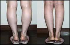 Calf muscles - Yuveo Clinic