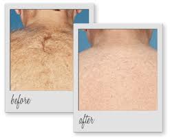 laser-hair-removal-before-after1