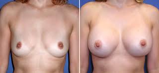 thailand-stemcell-breast-augmentation